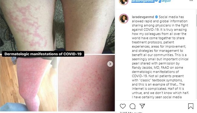 Se descubre nuevo posible síntoma de covid-19 que ataca sobre todo a jóvenes