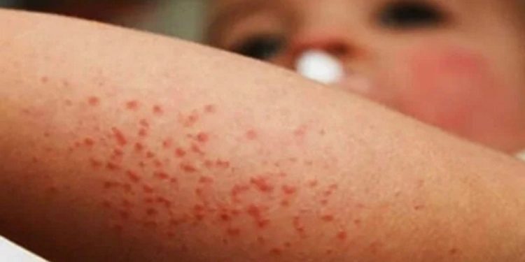 Alarma por Sarampión; Ya hay un caso en Campeche!