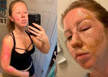 Turista con quemaduras demandará al personal del Bar Guatatos en Cancún