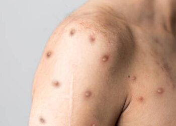 Ante brotes de viruela símica, OMS recomienda disminuir número de parejas sexuales