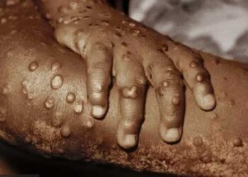 Lo que debemos saber sobre la viruela del mono