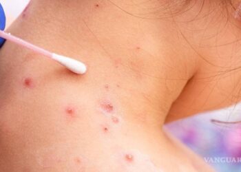 Brasil confirma la primera muerte por viruela del mono en América