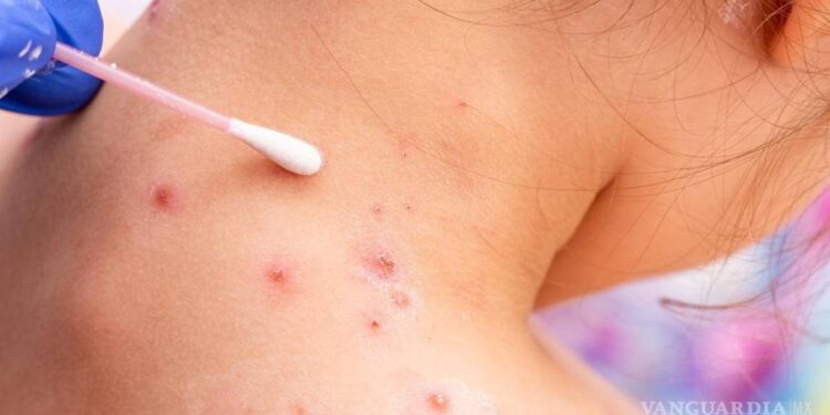 Brasil confirma la primera muerte por viruela del mono en América