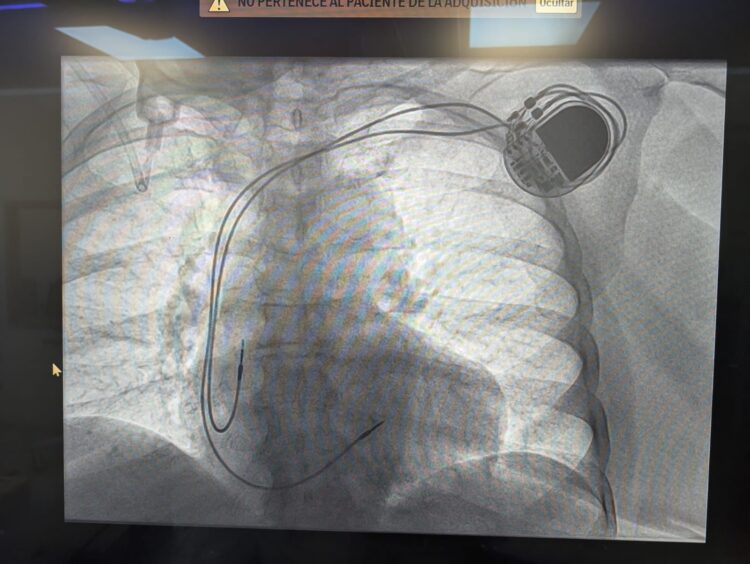 Implantación exitosa del primer marcapaso definitivo en Quintana Roo