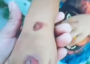 Abuela se hará cargo de niño quemado en Villas del Sol